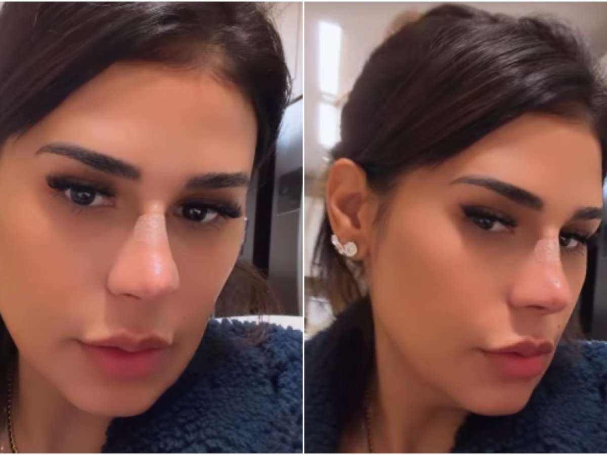 Simone Mendes fez plástica no nariz? Cantora revela procedimento realizado